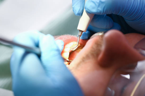 Best Emergency Treatment for Dental Infections or Abscesses in Shrub Oak, NY